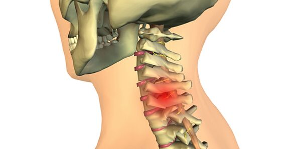 a nyaki gerinc exacerbációja